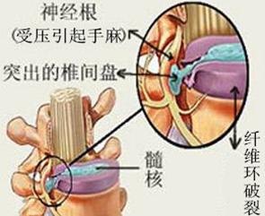 颈椎病手麻锻炼操视频,颈椎病引起手麻中药方