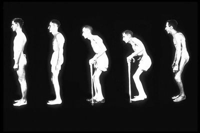 强直性脊柱炎不可告人的秘密,关于强直性脊柱炎的六大误解