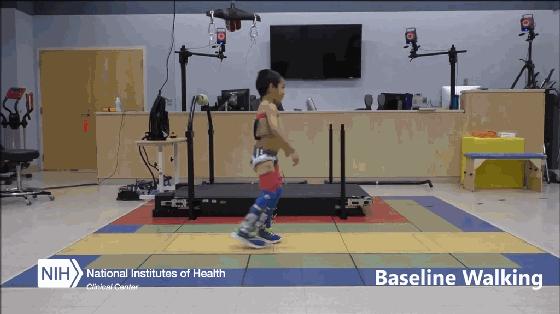 脑瘫儿最好的恢复情况,现在都是怎么处理脑瘫儿的