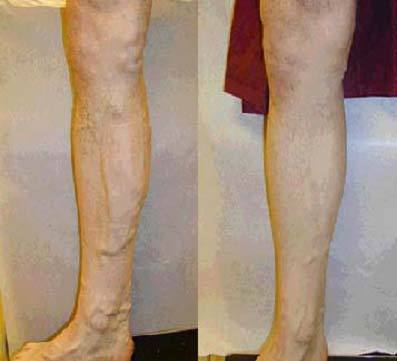 如何预防精索静脉曲张加重,长期久站怎么预防静脉曲张