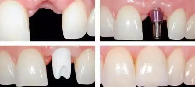 缺失下门牙可以做种植牙吗,门牙缺失不想种植牙怎么办