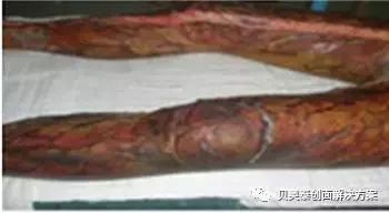 烧伤的治疗,烧伤的治疗土方