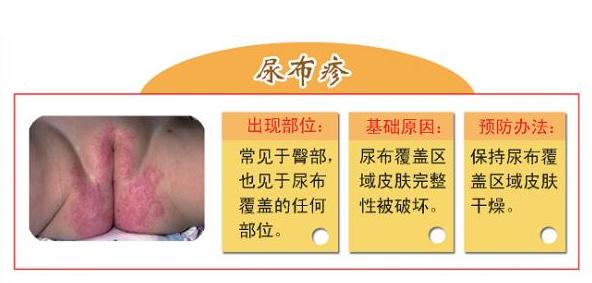 孩子尿布疹总反反复复怎么办,为什么老是反复会有尿布疹