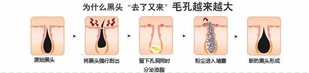 粉刺黑头去除最快方法,鼻子螨虫黑头怎么去除简单方法