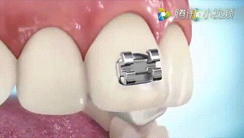 全瓷牙套怎么才算安装好,牙齿矫正有几种牙套图片