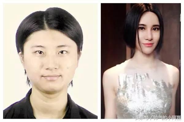 玻尿酸微整形丰下巴多少钱一针,下巴微整形要多少钱