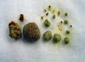 结石会不会影响宝宝,孕期结石发作了怎么缓解