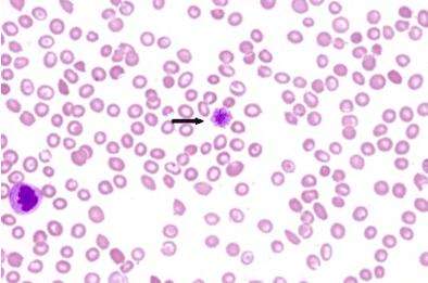 甲泼尼龙片一停过敏性紫癜就复发,儿童过敏性紫癜多久不复发算痊愈