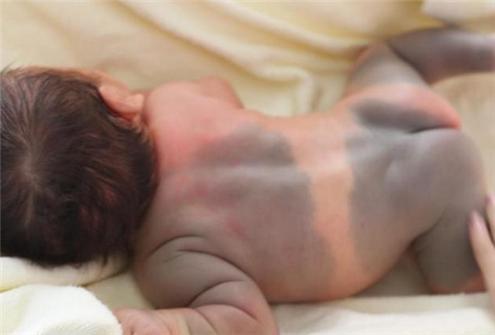 新生儿身上好多青色胎记怎么回事,新生儿很多胎记怎么回事