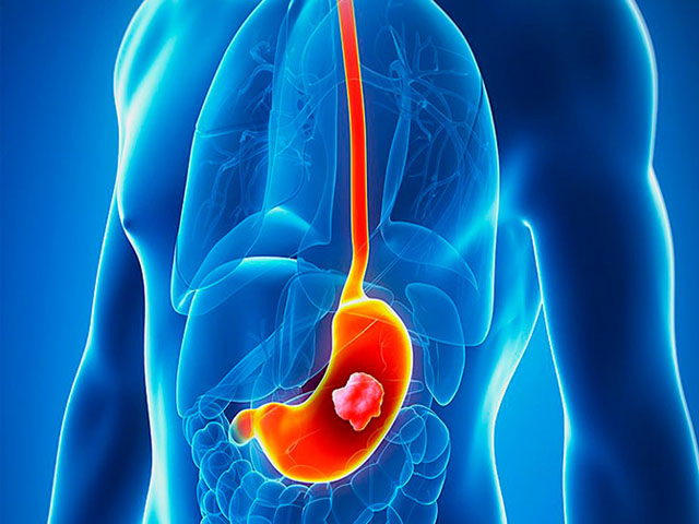 胃癌患者早期十大症状,胃癌详细解说