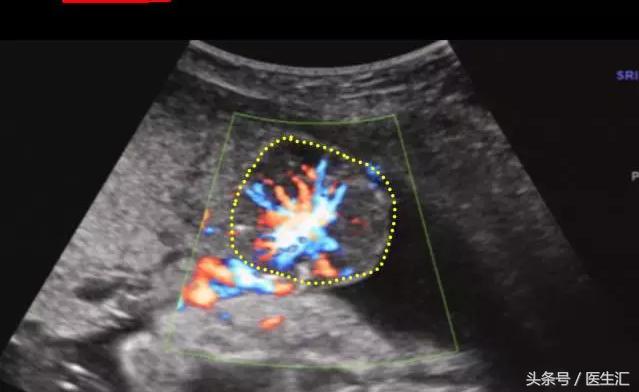 胎盘早剥是什么导致的,胎盘早剥是什么原因造成的胎儿肺炎