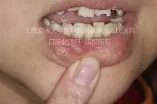 口腔溃疡太疼怎么上药,口腔溃疡很痛怎么办吃什么好得快