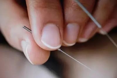 膝关节炎的针灸治疗的穴位,膝关节炎针灸五针疗法用何穴