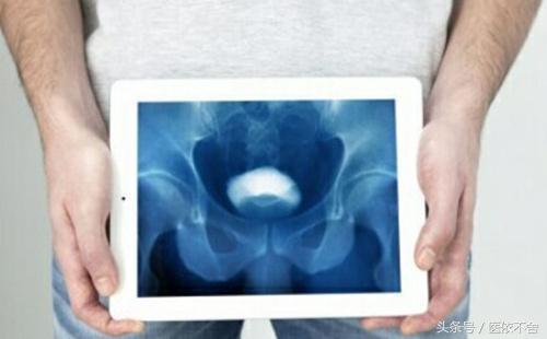 男性膀胱癌症状的早期表现,膀胱癌常见的发病因素