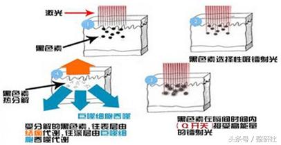 光电祛痘坑效果,光电祛斑拯救麻子脸