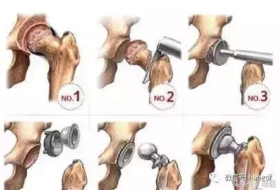 髋关节置换术护理疑难病例讨论,髋关节置换病人的护理与饮食