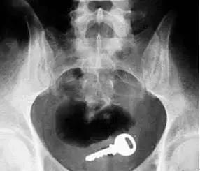 6岁女孩*体下**反复流脓，医院检查后家长惊呆了！