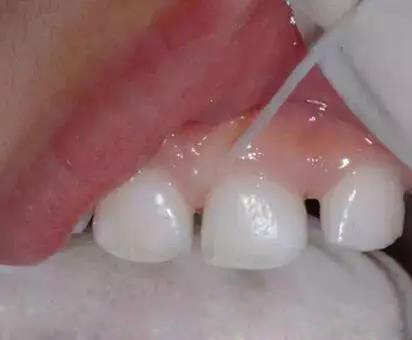 小孩牙齿表面一层黑能去掉吗,牙齿有块黑的怎么去掉