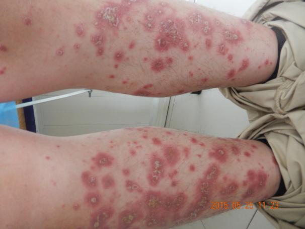 银屑病患者自述康复真实记录,银屑病患者自述真实经历