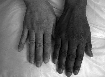 小夫妻皮肤白净，生下的早产宝宝却像非洲黑人，可怜的宝宝怎么了