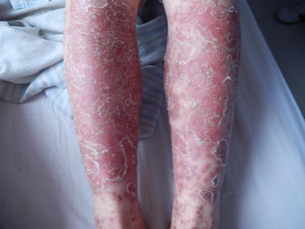 银屑病患者自述康复真实记录,银屑病患者自述真实经历