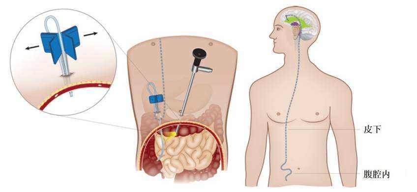 脑积水腹腔分流6例,脑积水脑室腹腔分流术病人照片
