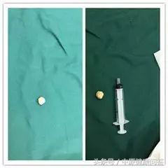 口腔下颌下腺结石症状,口腔内发现大量扁桃体结石