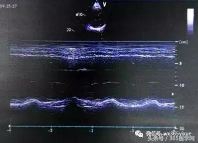 高超：高龄心肾功能不全患者使用ADR技术开通CTO病变一例