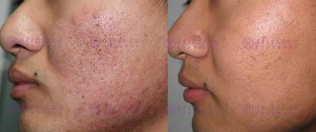 三角区痘疤的正确消除方法,专家告诉你怎么祛除脸上的痘痘