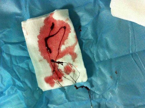 用玻尿酸打了鼻子,用玻尿酸注射隆鼻