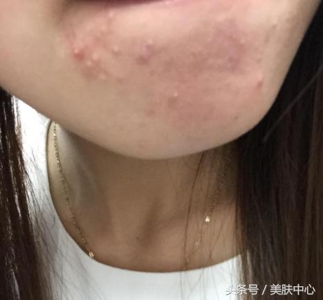 如何去掉下巴的痘痘痕迹,长期下巴痘痘去除小妙招