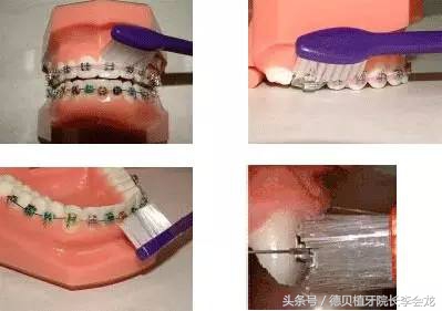 箍牙过程中有牙缝正常吗,箍牙的过程疼吗