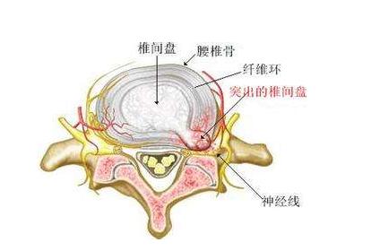 腰椎间盘突出0.85cm不手术可以吗,腰椎间盘突出不疼吃什么药有效