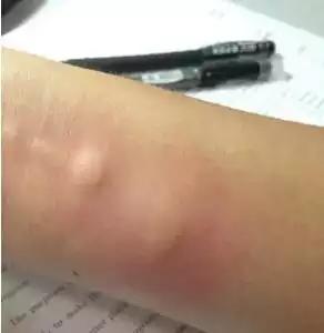 孩子们最害怕的10种虫子,家长反应孩子被虫子咬了