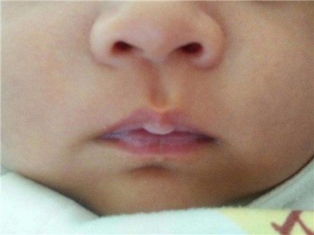 新生儿嘴上有白点怎么回事,新生儿嘴上有白泡