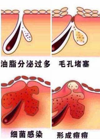 痘痘里面挤出来的白色东西是什么,痘痘挤出来白色硬粒后再挤出血