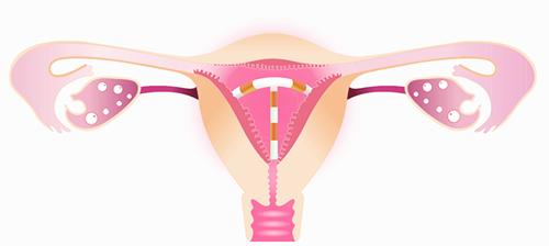 节育环有哪些注意事项？医生给出三点建议！