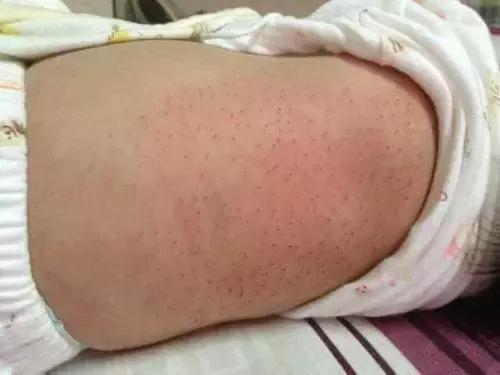 新生儿身上长猪毛怎么办,宝宝身上长满了猪毛