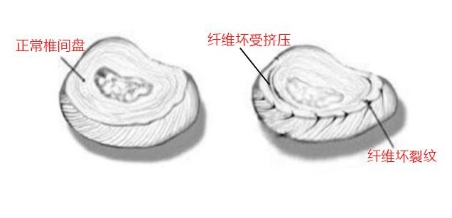 腰椎间盘突出按严重程度如何分类,腰椎间盘突出十种治疗方法