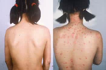 农村常见,城里人却没怎么吃过的芋头,却能治好顽固牛皮癣