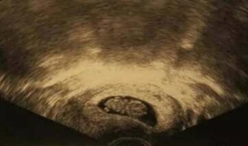 早孕做宫腔超声会不会流产,怀孕流产超声能看出来吗