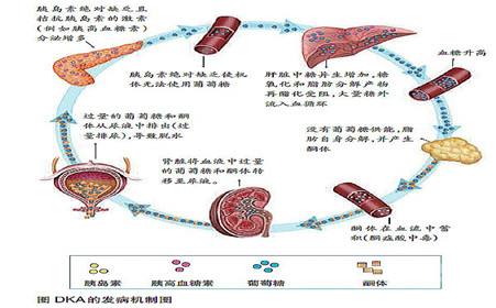 糖尿病酮症酸中毒的症状怎么治疗,糖尿病酮症酸中毒什么症状和表现