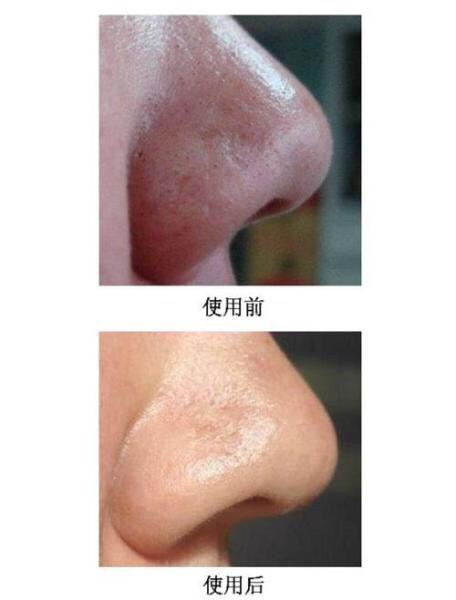 如何去黑头收缩毛孔小妙招,实用去黑头收缩毛孔小妙招