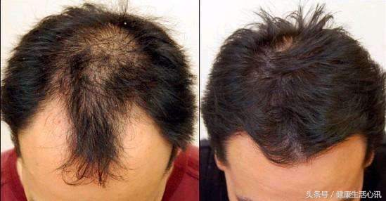 头发不出油但是脱发是怎么回事,高中女孩头发出油脱发怎么回事