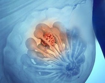 舒卿祖传针灸治疗乳腺增生,乳腺增生腋下淋巴肿大怎么扎针灸