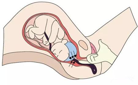 胎儿分娩时脐带先露,分娩时脐带先露危险吗