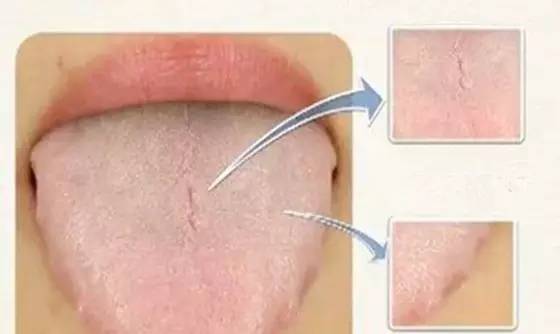 湿气重的人要忌吃哪些,湿气太重有忌口吗