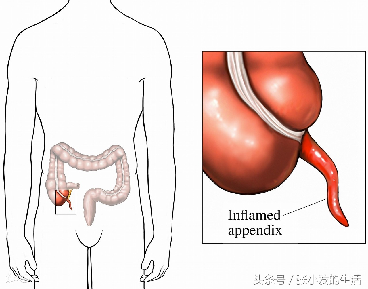 需与急性阑尾炎相互鉴别的疾病