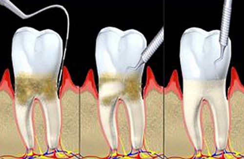 牙周不好整牙,牙周不好就要做牙周刮治吗