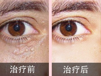 眼睛周围的汗管瘤激光多少钱,眼睛周围的汗管瘤怎么才能治好呢